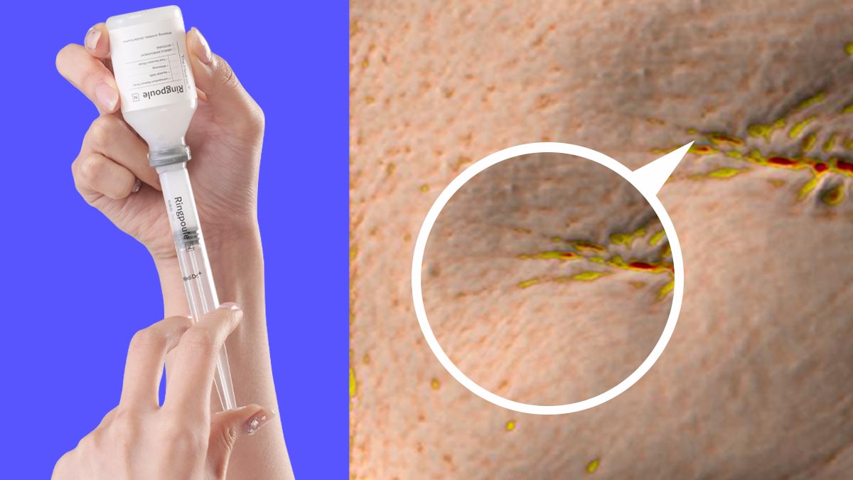 단 7일만에 눈에 보이는 확실한 주름개선, 임상완료 링플!