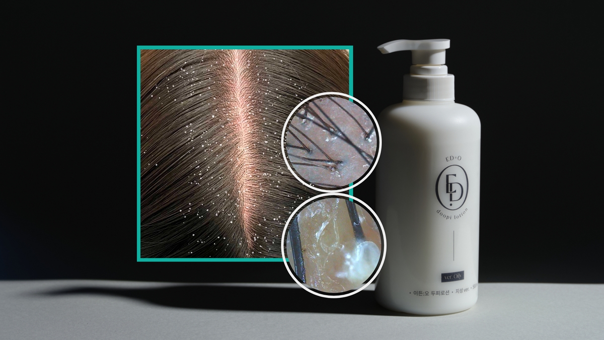 Encore | ‘I just washed my hair...’ Solutions for Oily Scalp Woes (Not Shampoo)